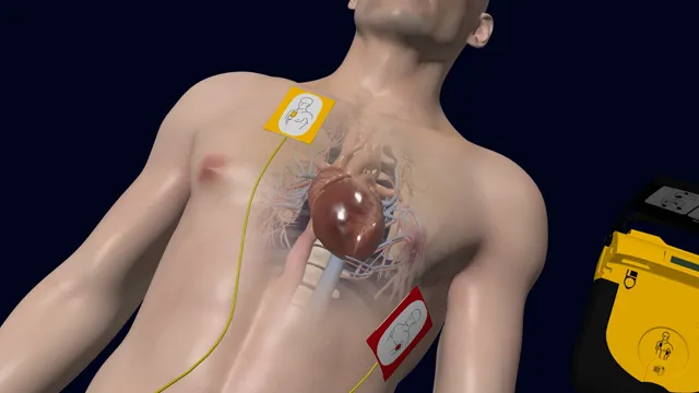 eLearning Animations Medical training video animation of a man with a defibrillator hooked to his chest.